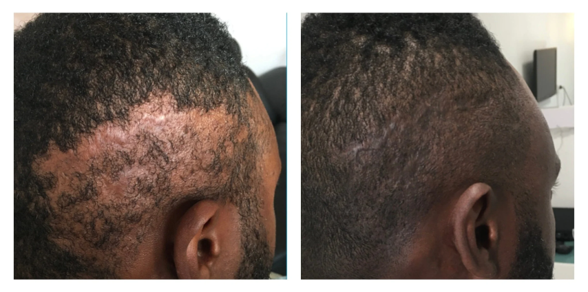 Découvrez la MicroPigmentation capillaire 3D : une solution non-chirurgicale, durable et naturelle contre la calvitie. Résultat immédiat, sans douleur ni cicatrice.